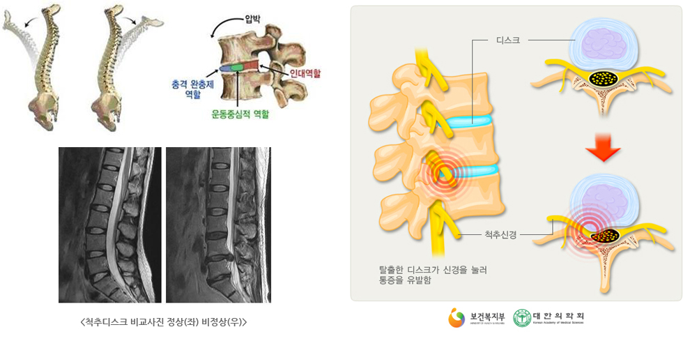 척추디스크 비교사진 정상(좌) 비정상(우) &mdash; 탈출한 디스크가 신경을 눌러 통증을 유발하는 척추디스크